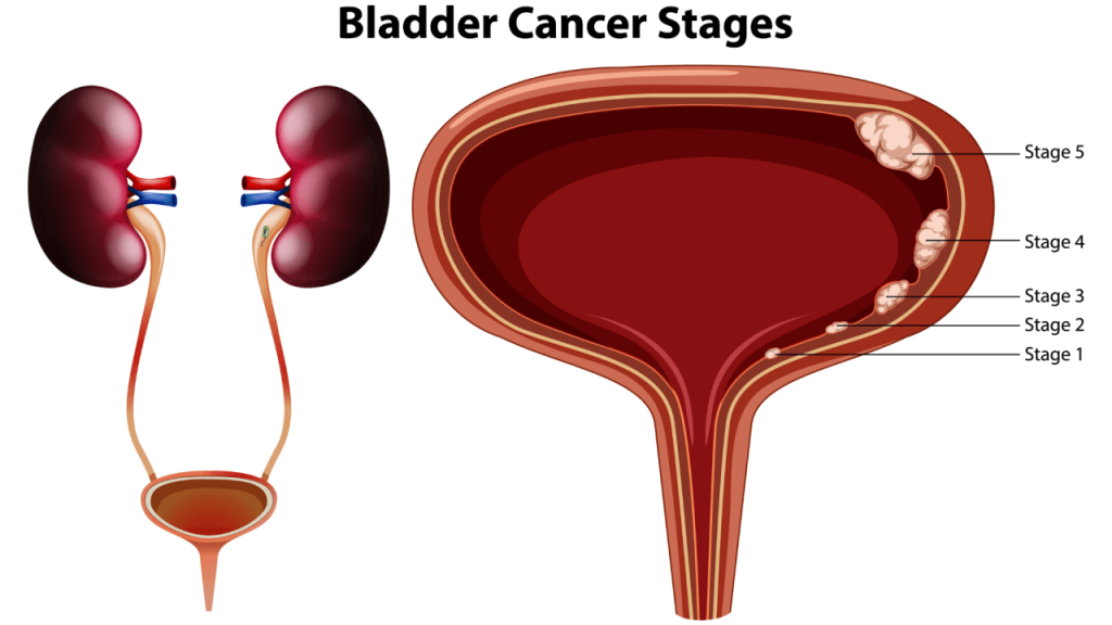 Bladder Cancer - Symptoms, Types & Treatment | MITR Hospital