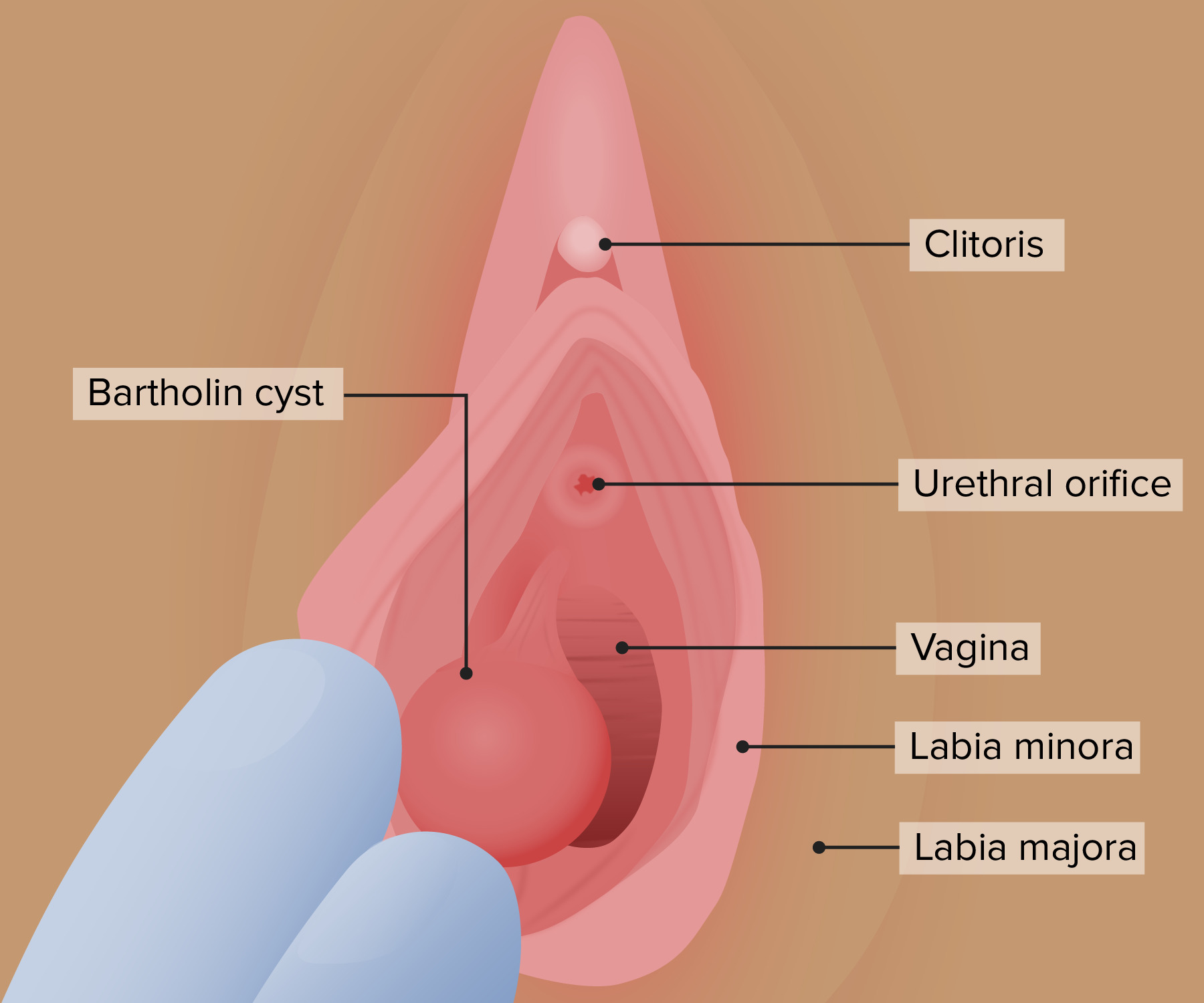 Bartholin cyst/abscess