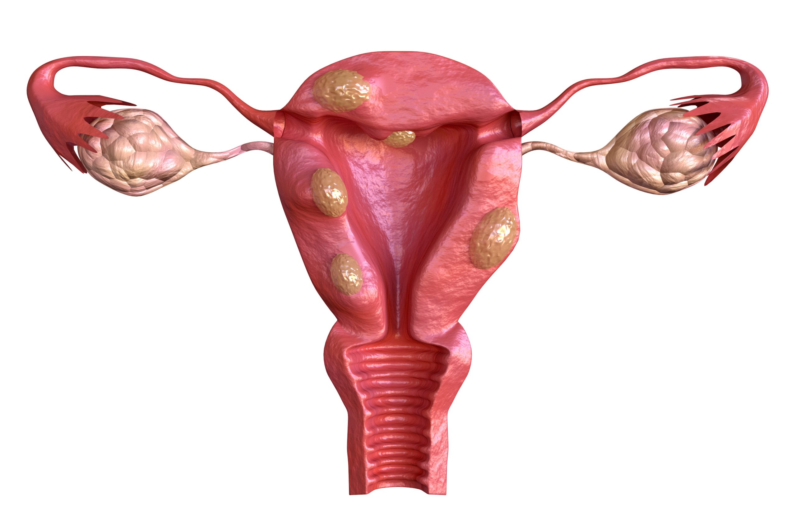 Fibroid Removal