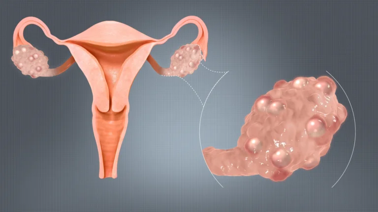 Decoding PCOD: Unraveling the Mystery of This Hormonal Disorder