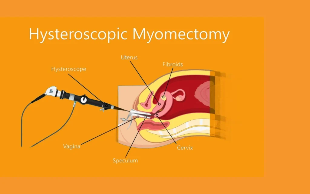 Empowering Women: A Comprehensive Guide to Hysteroscopic Myomectomy for Menstrual Health!