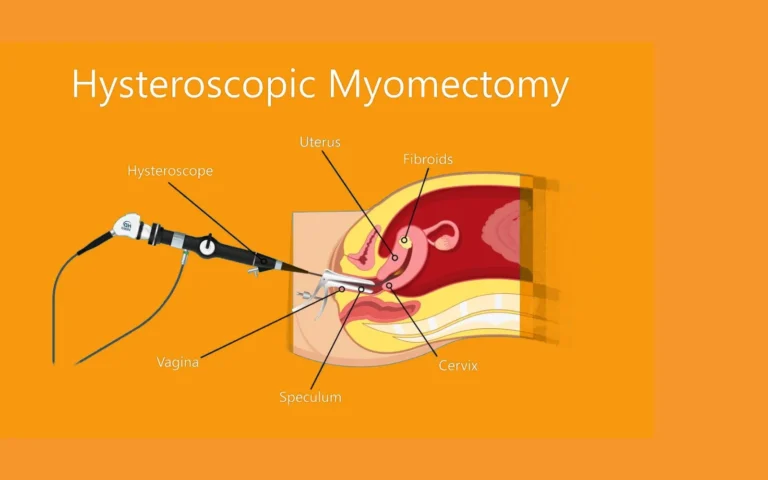 Empowering Women: A Comprehensive Guide to Hysteroscopic Myomectomy for Menstrual Health!