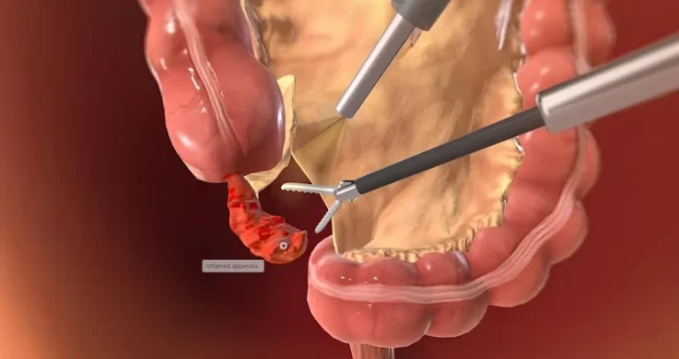 All Things Appendix