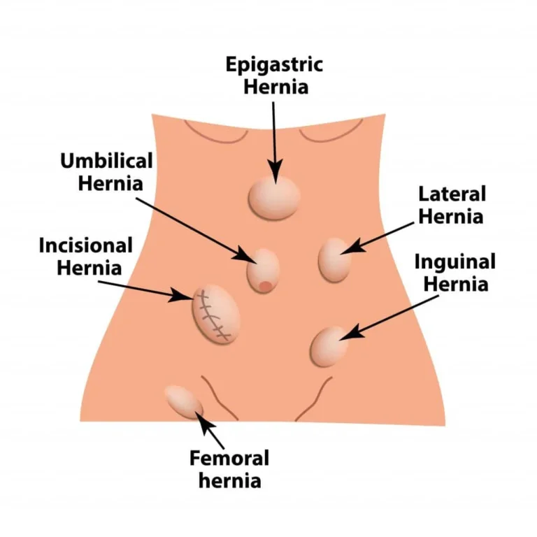 Hernias in Women: Unique Considerations and Treatment Options