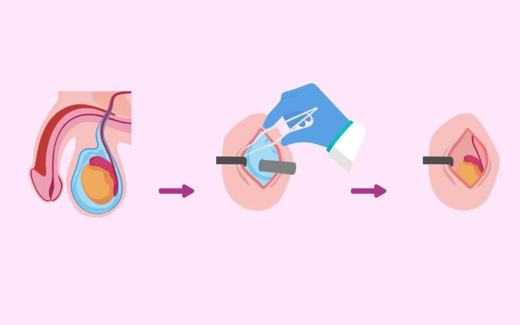 In Adult males Hydrocele Surgery: Addressing Concerns About Complications and Risks