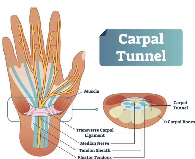 Carpal Tunnel Awareness: Debunking Myths and Misconception