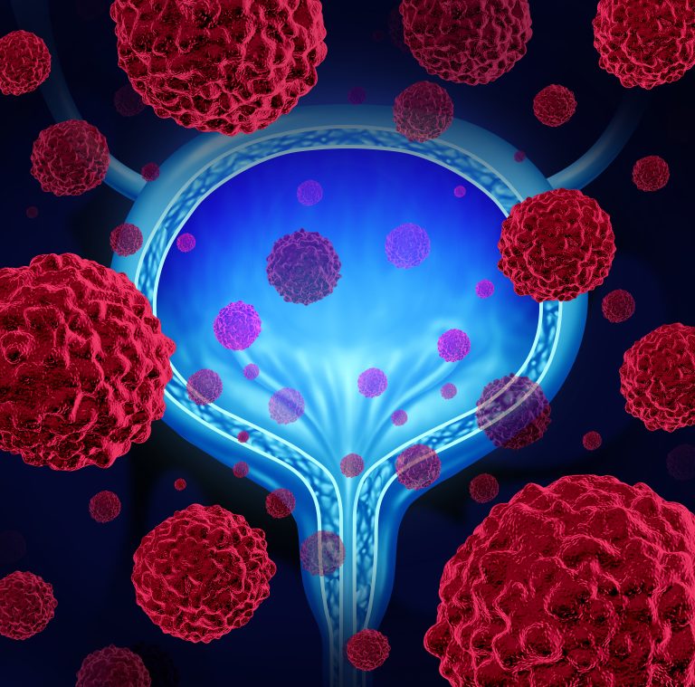 Navigating Bladder Cancer: Empowering Tips for Coping with Diagnosis and Treatment