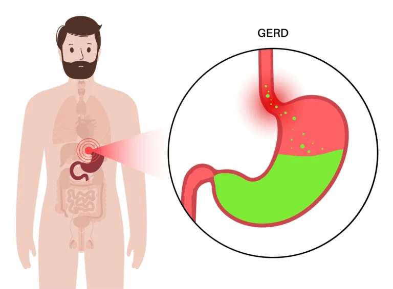 Debunking GERD Myths: Common Misconceptions About Acid Reflux