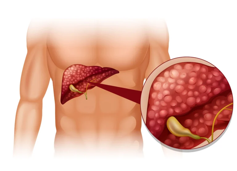 Embracing Life After Gallstones: Navigating Cholecystectomy and Long-Term Wellness