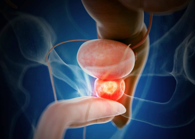 Navigating Prostate Cancer: Understanding Symptoms, Treatment, and Lifestyle