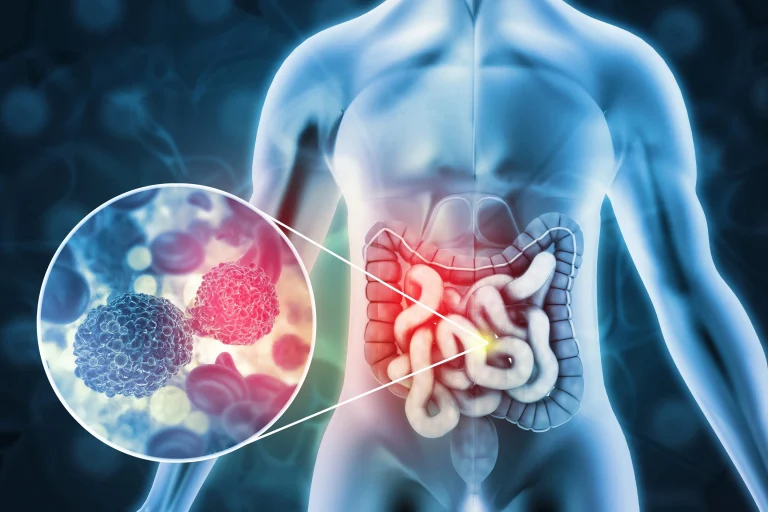 The Vital Role of Colonoscopies in Early Detection of Colorectal Cancer