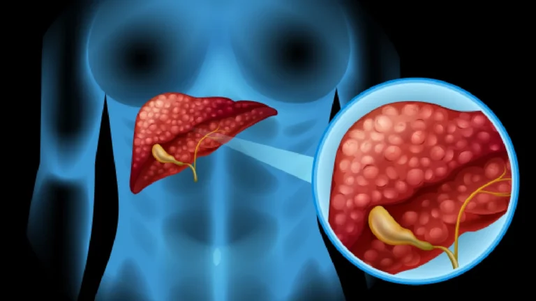Gallstones: the unwelcome pebbles disrupting life’s internal harmony.