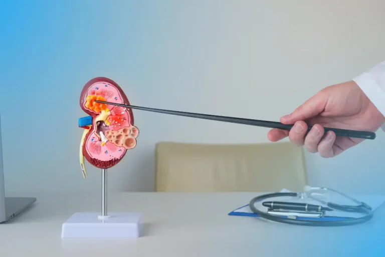 Will I Remain Stone-Free Forever After Kidney Stone Removal?