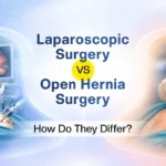 Laparoscopic vs Open Hernia Surgery: How Do They Differ?