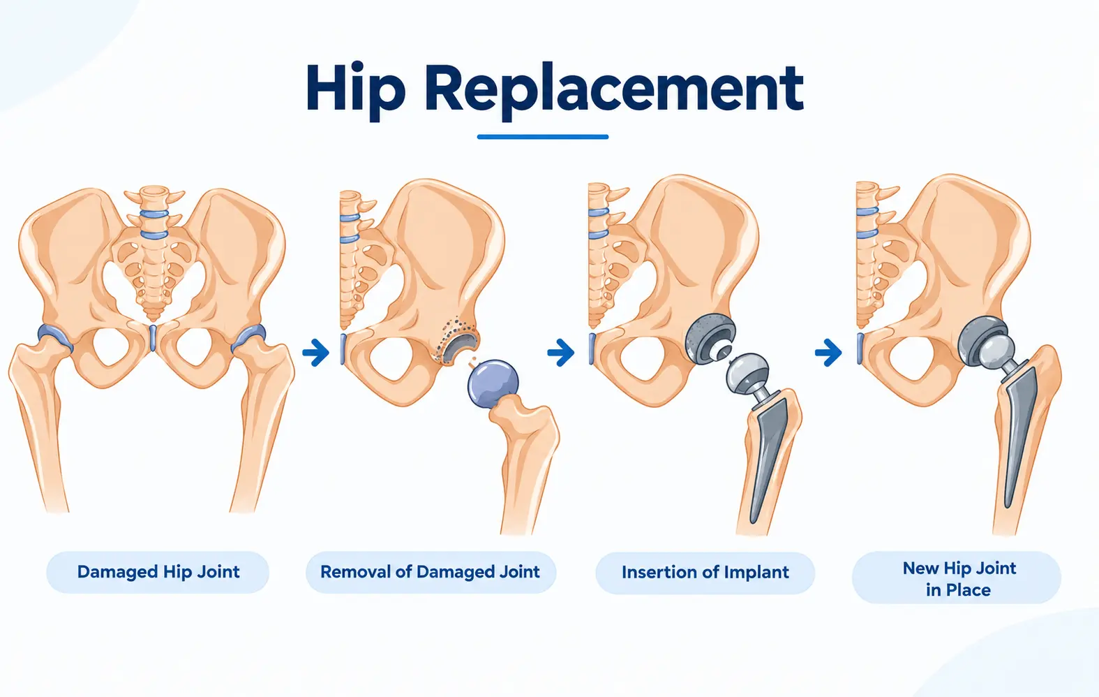 Hip replacement: damaged hip joint, removal of damaged joint, insertion of implant, new hip joint in place