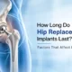 How Long Do Hip Replacement Implants Last? Factors That Affect Longevity