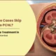 PCNL surgery for kidney stones: why some cases skip straight to PCNL